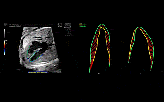 Tecnologia fetal HQ di Voluson