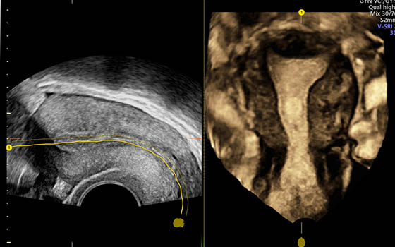 Tecnologia Uterine Trace di Voluson