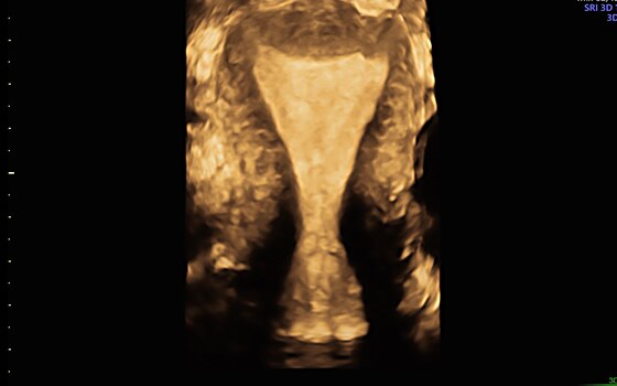 Tecnologia Uterine Trace di Voluson